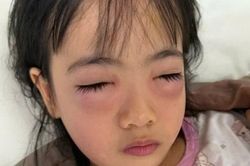 Bé gái 5 tuổi bị viêm kết mạc dị ứng sau khi chơi thổi bong bóng xà phòng