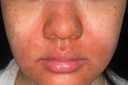 Peel da mặt làm đẹp, cô gái mọc chi chít mụn nước, vỡ chảy dịch