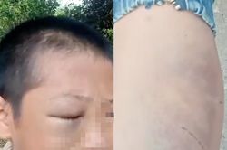 Xác minh clip bé trai mắt bầm tím, khóc kêu cứu vì 'nhiều lần bị đánh đập'