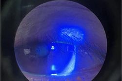 Suýt mất thị lực một mắt vì môn thể thao đang 'gây sốt'