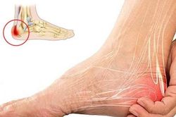 Biểu hiện điển hình khi mắc gai gót chân, đừng chủ quan với những cơn đau ở bàn chân