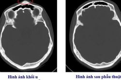 Bệnh viện Việt Nam - Thụy Điển Uông Bí phẫu thuật thành công ca u xương sọ hiếm gặp