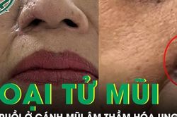 Nốt ruồi ở cánh mũi âm thầm hóa ung thư, phá hủy gần toàn bộ mũi người phụ nữ