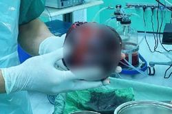 Chủ quan đau bụng nhẹ, người đàn ông suýt mất mạng vì khối u bằng quả dưa lưới