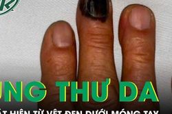 Bàng hoàng phát hiện ung thư da từ vệt đen dưới móng tay