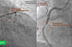 Lần đầu đặt stent tự tiêu cứu bệnh nhân nhồi máu cơ tim tại ĐBSCL