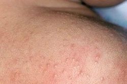 Mùa hè nhiều rôm sảy cần xử trí ra sao?