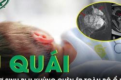 Cứu trẻ sơ sinh 10 ngày tuổi mang khối u hiếm gặp, chèn ép toàn bộ ổ bụng