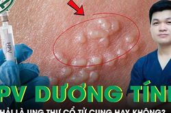 Có phải HPV dương tính là bị ung thư cổ tử cung không?