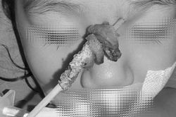 Tai nạn hy hữu: Bé gái 2,5 tuổi bị que xiên thịt đâm sâu, nguy cơ xuyên sọ não