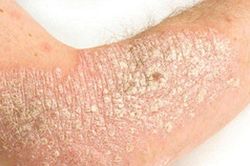 Mắc căn bệnh mãn tính, nhiều người mặc cảm 'không dám bắt tay'