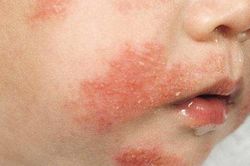 Cảnh báo dị ứng đạm sữa bò