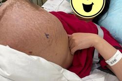 Chiếc bụng mang thai đôi chằng chịt vết rạn, ai nhìn cũng xót xa: 'thở thôi cũng mệt'