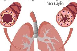 Khi nào người bệnh hen cần đến viện ngay lập tức?