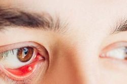 Nguyên nhân gây cộm mắt và cách khắc phục