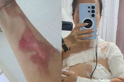 Nổ nồi xông hơi khi gội đầu dưỡng sinh, khách nữ bị bỏng độ 2