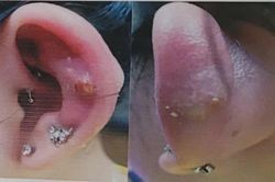 Bé gái nhập viện vì khuyên tai tụt sâu vào bên trong