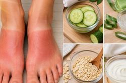 5 c&aacute;ch tự nhi&ecirc;n gi&uacute;p l&agrave;m dịu, cải thiện t&igrave;nh trạng ch&aacute;y nắng ở b&agrave;n ch&acirc;n