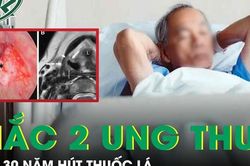 Người đ&agrave;n &ocirc;ng 56 tuổi mắc c&ugrave;ng l&uacute;c hai ung thư sau 30 năm h&uacute;t thuốc l&aacute;
