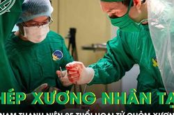 Ghép xương nhân tạo cho nam thanh niên 25 tuổi bị hoại tử chỏm xương đùi