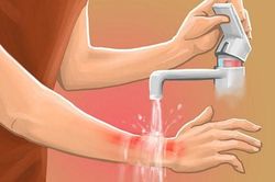 Bỏng nhiệt: Sơ cứu đúng cách để tránh biến chứng