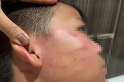 Vụ giáo viên nước ngoài tát học sinh: Gia đình nói bé trai bị thủng màng nhĩ