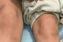 Ăn thịt nướng cuốn xà lách, bé trai 6 tuổi nổi đầy vết bầm tím 'bất thường'
