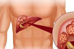 Người mắc viêm gan B sẽ rất nguy hiểm nếu tự ý làm điều này