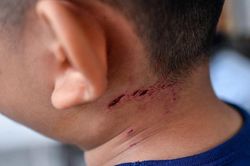 Một bệnh nguy cơ tăng dồn dập, gần như 100% không qua khỏi