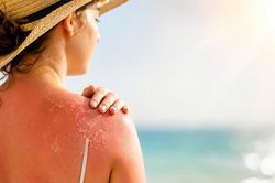 Cháy nắng: Cảnh báo tổn thương da trong mùa nắng nóng