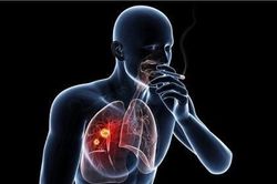 Ung thư đầu cổ có liên quan trực tiếp đến thuốc lá