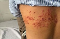 Người đàn ông Hải Phòng mắc zona thần kinh biến chứng nặng do chủ quan