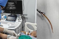 Đau bụng suốt 10 ngày, bất ngờ phát hiện tăm tre đâm thủng đại tràng