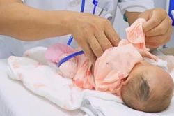 Mở lồng ngực, thắt ống tim, ca đại phẫu nghẹt thở cứu bé sinh non nặng 900g
