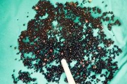 Đau bụng suốt nhiều tháng, người đàn ông 43 tuổi sốc nặng khi bác sĩ gắp ra thứ 'đáng sợ' trong bụng