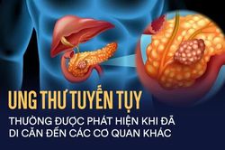 Cơ hội kéo dài thời gian sống của bệnh nhân ung thư tuyến tụy di căn