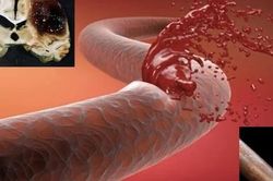 Người đàn ông 43 tuổi xuất huyết não thừa nhận 1 sai lầm nhiều nam giới Việt mắc phải