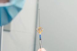Chữa thành công bệnh rung nhĩ bằng năng lượng xung điện (PFA)