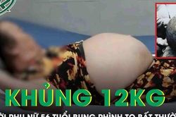 Bụng to bất thường, người phụ nữ 'kh&oacute;c ngất' khi ph&aacute;t hiện khối u khổng lồ nặng tới 12kg
