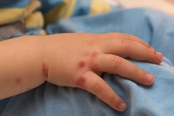 Cứu sống trẻ 23 th&aacute;ng tuổi nguy kịch v&igrave; mắc tay ch&acirc;n miệng