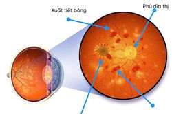 Tăng huyết áp ảnh hưởng đến thị lực như thế nào?