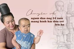 Chuyện về người đàn ông 34 tuổi mang hình hài đứa trẻ lên ba