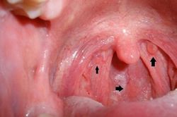 Dấu hiệu nhận biết sớm ung thư vòm họng hiệu quả