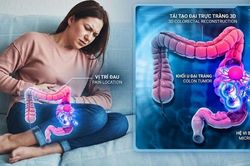 Ung thư đại trực tr&agrave;ng ở phụ nữ: Những triệu chứng &acirc;m thầm đừng n&ecirc;n ng&oacute; lơ