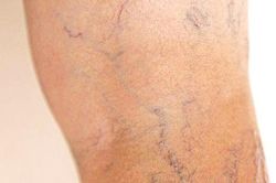 8 cách giúp cải thiện bệnh suy giãn tĩnh mạch tại nhà