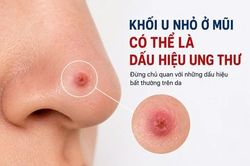 Phát hiện sớm ung thư da từ mụn nhỏ trên mũi