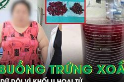 C&ocirc; g&aacute;i nặng 120kg đau bụng dữ dội v&igrave; hoại tử khối u buồng trứng xoắn 20cm