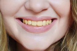 Chuyên gia chỉ ra 4 thực phẩm làm răng ố vàng, đánh mãi vẫn không trắng