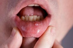 Đi khám vì dấu hiệu lạ, người đàn ông ngỡ ngàng khi biết mắc ung thư