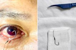 Cấp cứu thành công cho người đàn ông bị lưỡi câu móc vào mắt khi đi câu cá